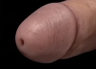 Photograph of a circumcised glans, permanently exposed